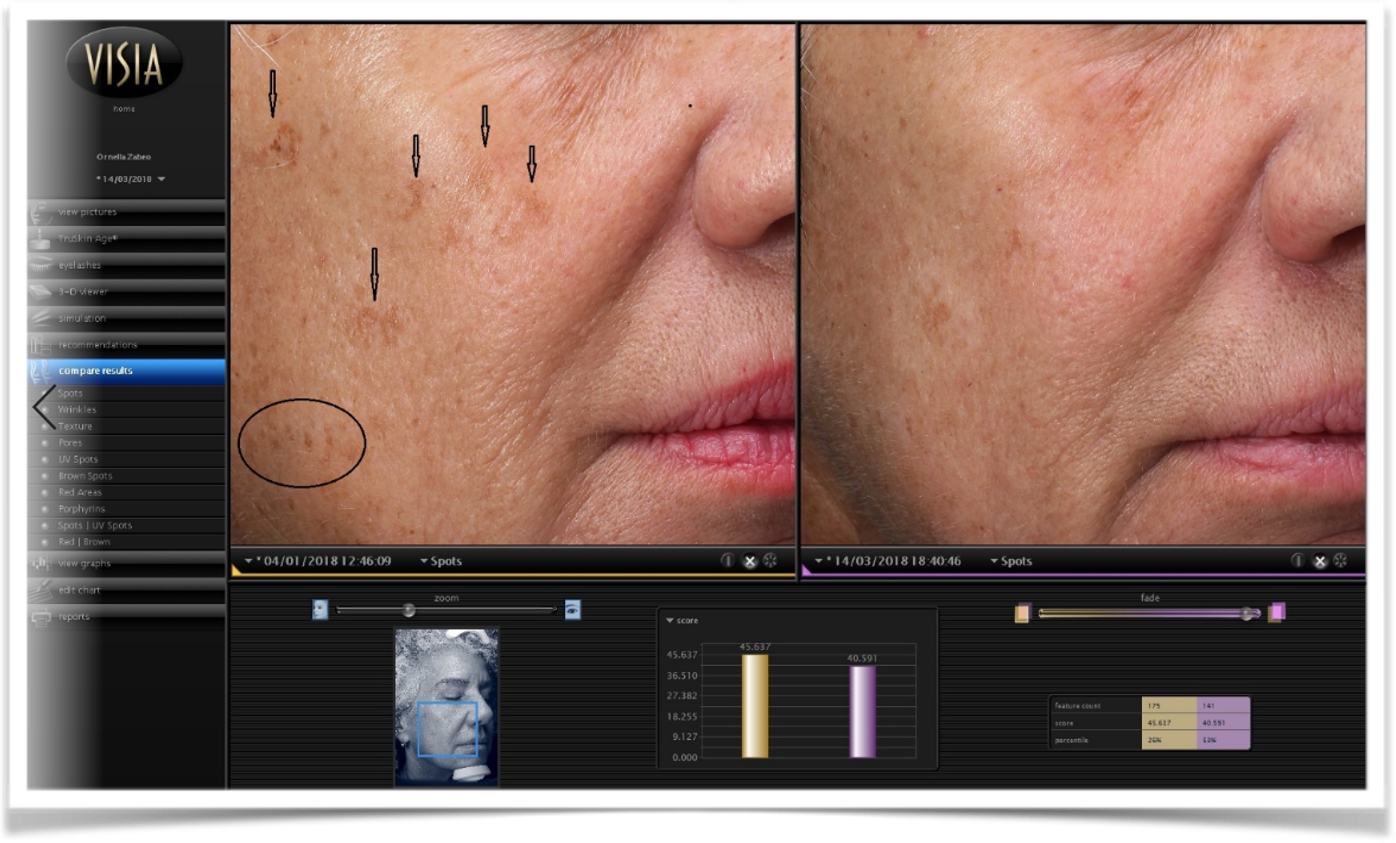 JOLI360 before and after treatment